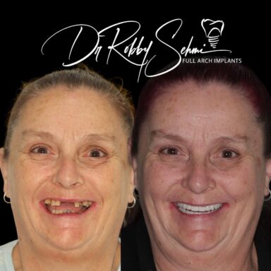 Implant2